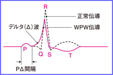 WPW症候群波形