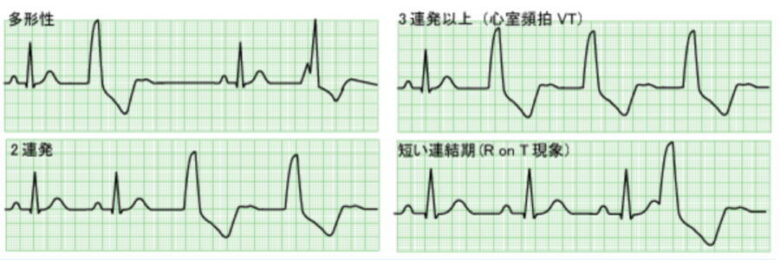 心室性期外収縮