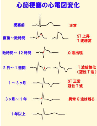 心筋梗塞の心電図時間変化