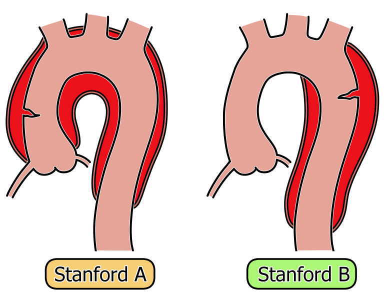 大動脈解離スタンフォード分類