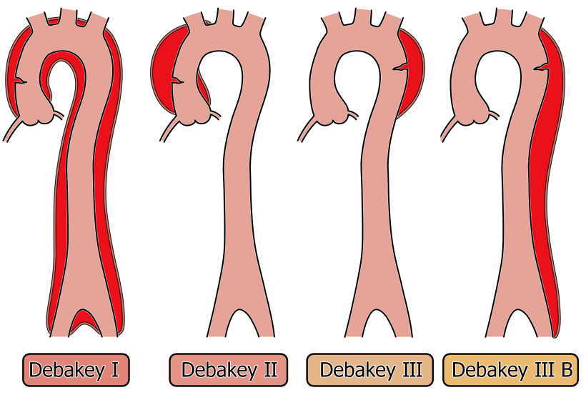 大動脈解離ドベーキ分類