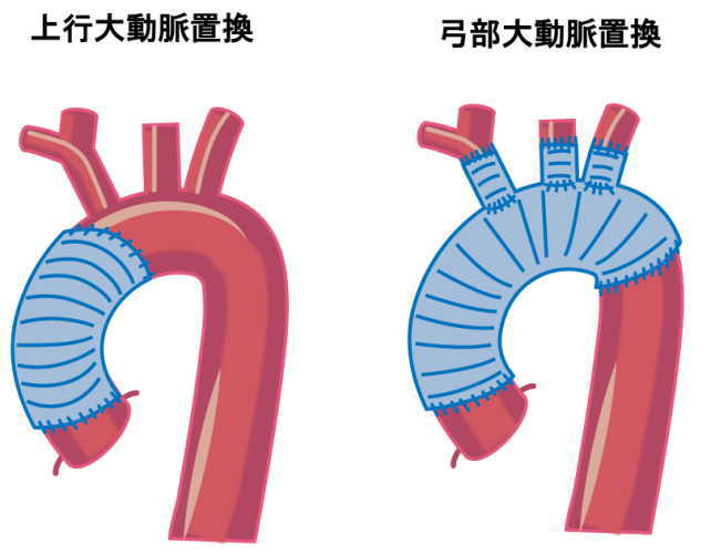 大動脈解離人工血管置換術