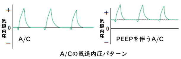 A/Cの気道内圧パターン