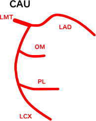 冠動脈血管造影 左冠動脈CAU