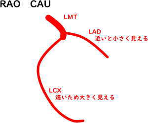 冠動脈血管造影 左冠動脈RAO CAU