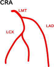 冠動脈血管造影 左冠動脈CRA