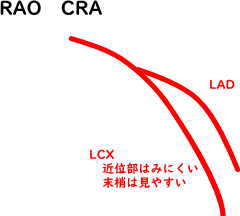 冠動脈血管造影 左冠動脈RAO CRA