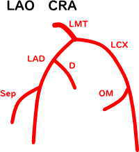 冠動脈血管造影 左冠動脈LAO CRA