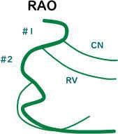 冠動脈血管造影 右冠動脈RAO
