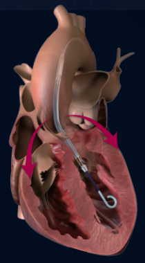 補助循環IMPELLA