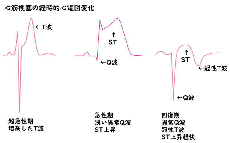 心筋梗塞の経時的心電図変化