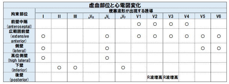 心筋梗塞と12ch心電図変化