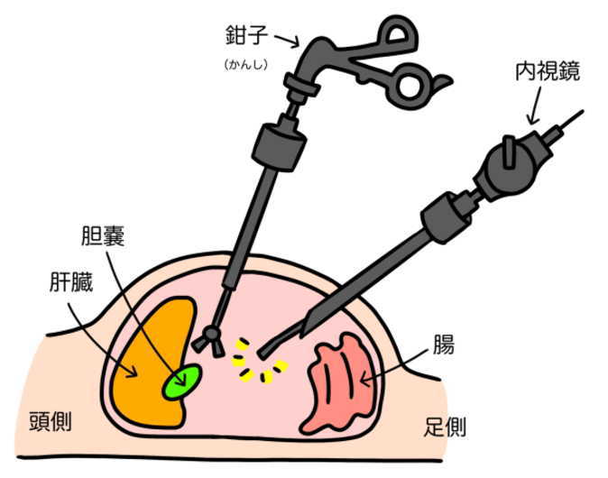 腹腔鏡下胆嚢摘出術