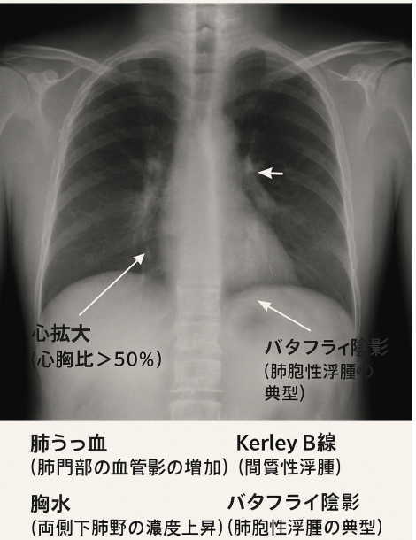 心ん不全胸部レントゲン